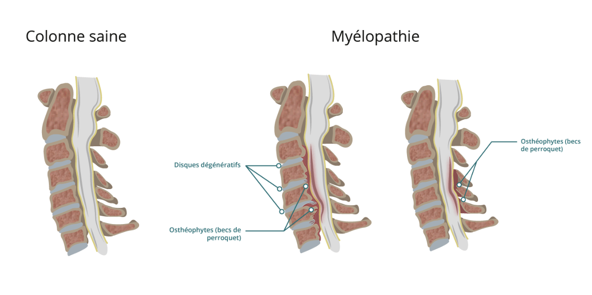 Myélopathie Cervicarthrosique : Diagnostic, Traitement, Prévention