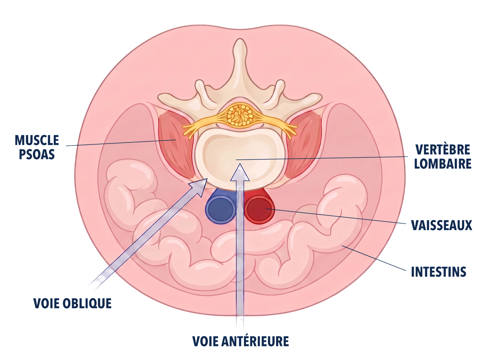 Coupe de l'abdomen vue de dessus&nbsp;: la voie antérieure arrive droit devant la colonne, entre les deux gros vaisseaux, tandis que la voie oblique arrive de biais, en avant du muscle psoas et à côté des vaisseaux, pour atteindre le disque sans passer par les intestins
