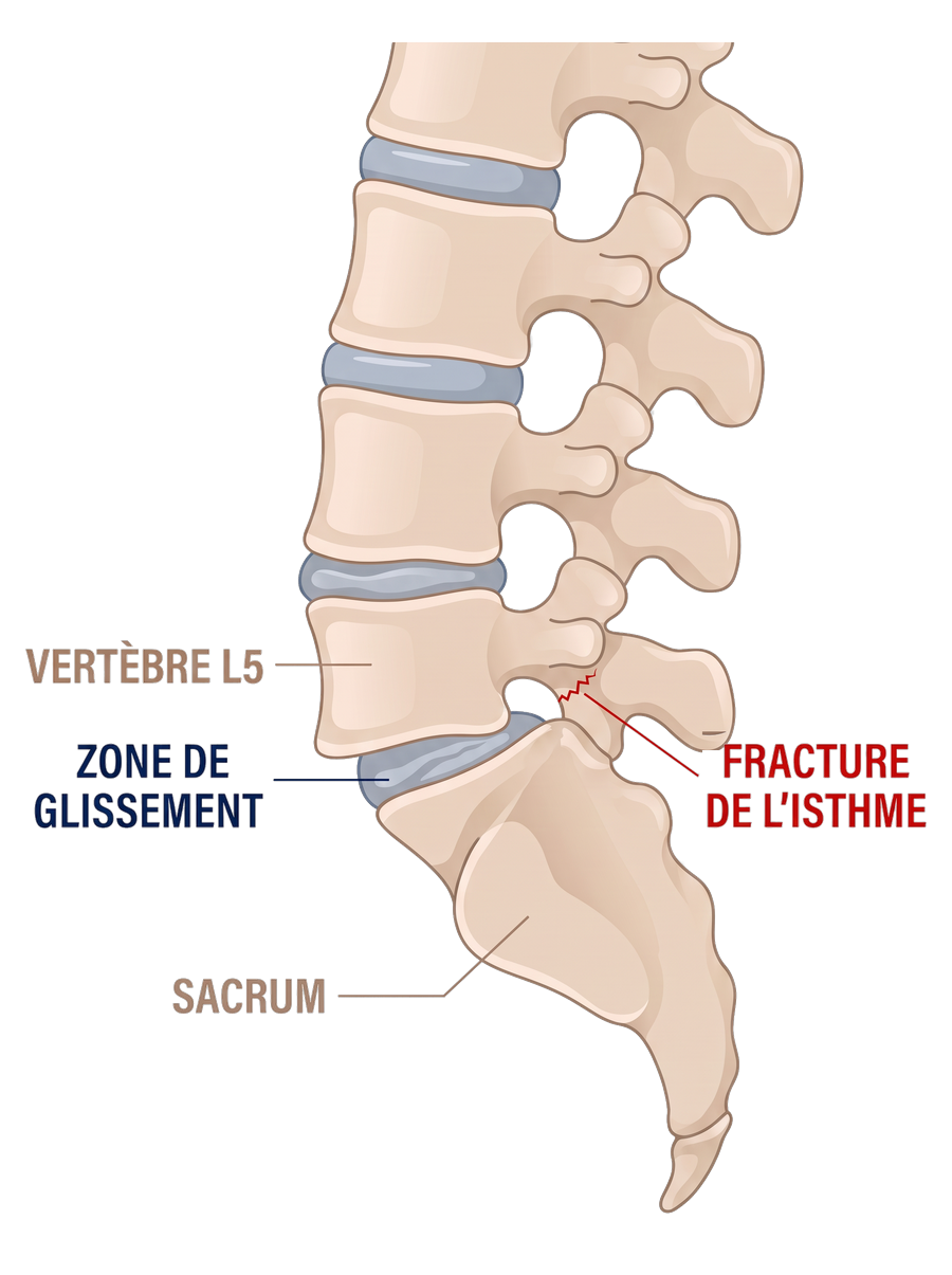 Schéma d'un spondylolisthésis par lyse isthmique&nbsp;: fracture de l'isthme et glissement de L5 sur le sacrum