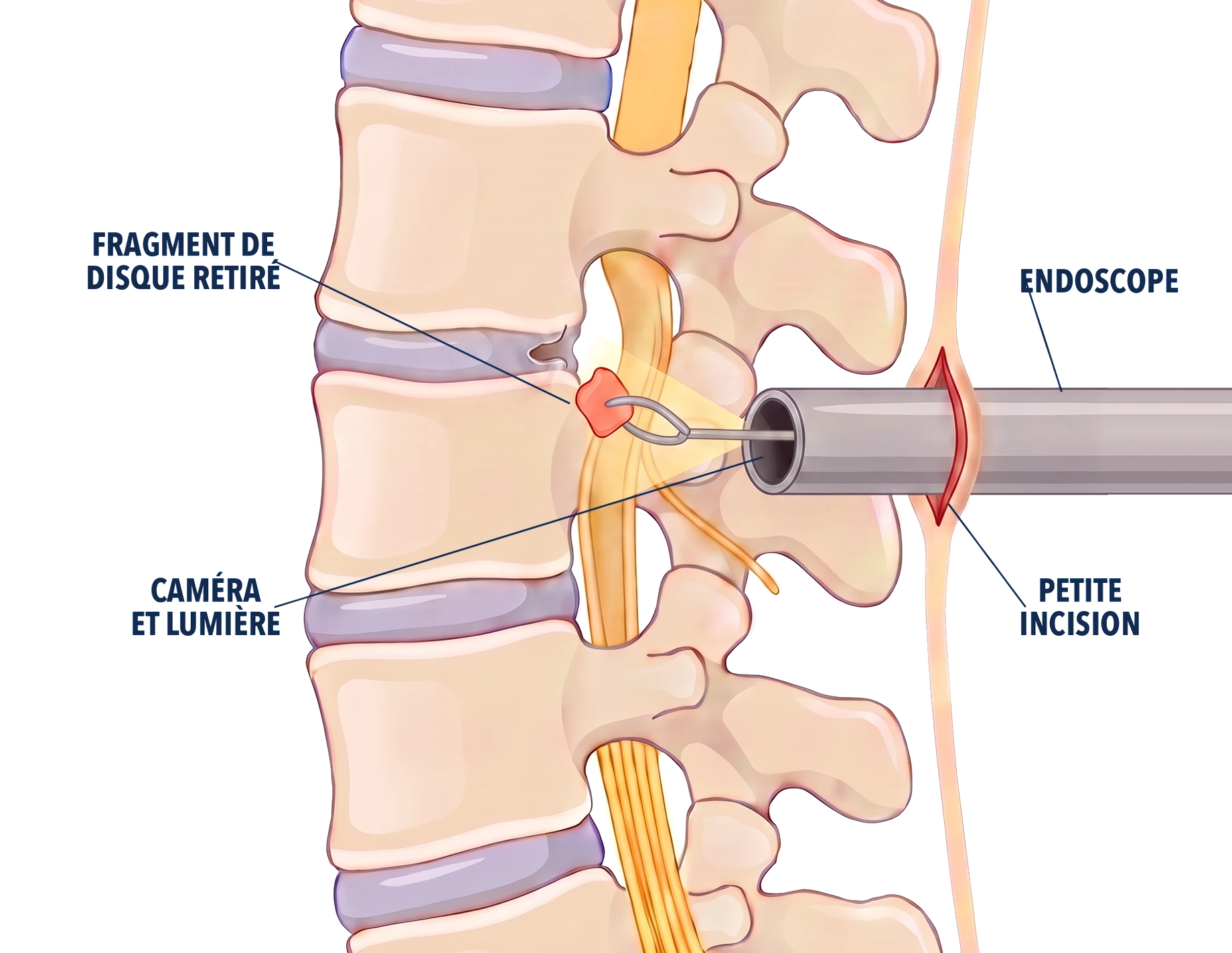 Schéma de la chirurgie endoscopique de la colonne&nbsp;: l'endoscope, introduit par une petite incision, s'arrête juste en arrière de la colonne&nbsp;; sa caméra et sa lumière éclairent le fragment de disque tombé dans le canal, que la pince saisit pour le retirer par le tube